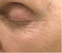 Laser Skin Resurfacing for Lines Under eyes